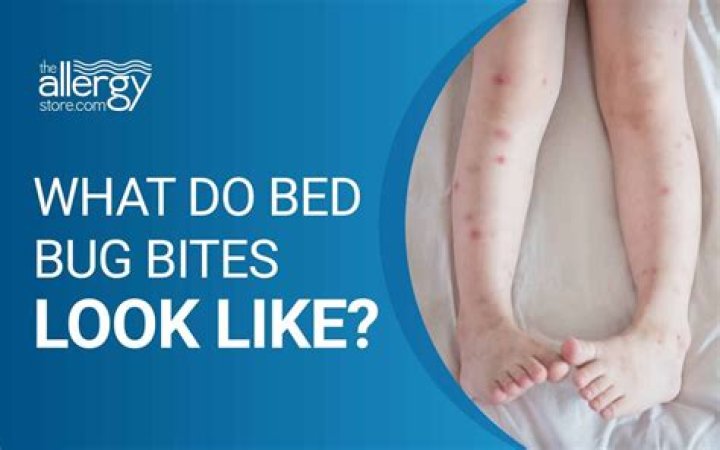 What does a bed bug rash look like?