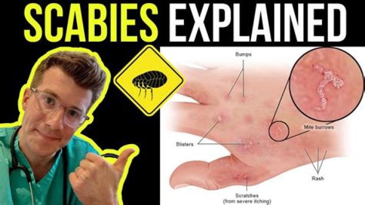 What does a scabies bite look like?
