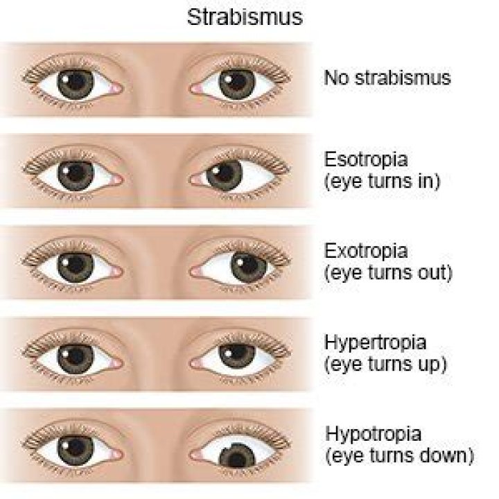 What happens if strabismus is untreated?