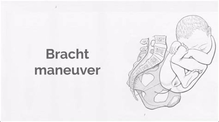 What is Bracht maneuver?