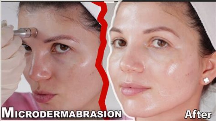 What is microdermabrasion facial?