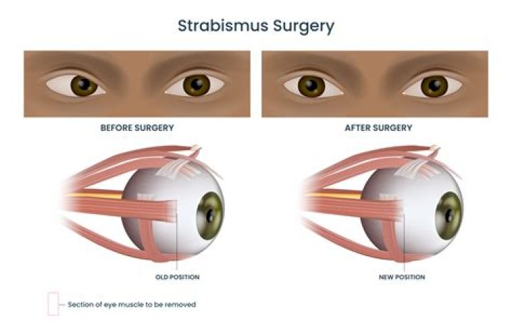 What is the best age for strabismus surgery?