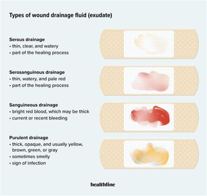 What is the difference between exudate and drainage?