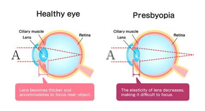 What is the difference between multifocal and presbyopia?