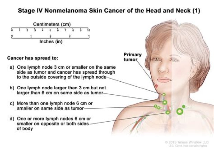 What size lymph node is concerning in neck?