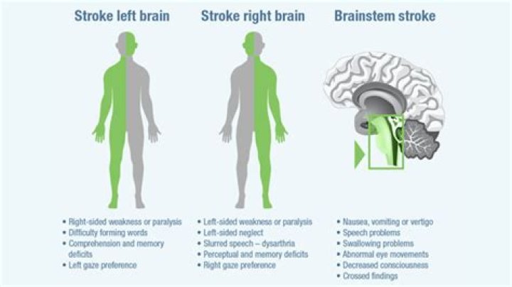 What type of stroke affects emotions?