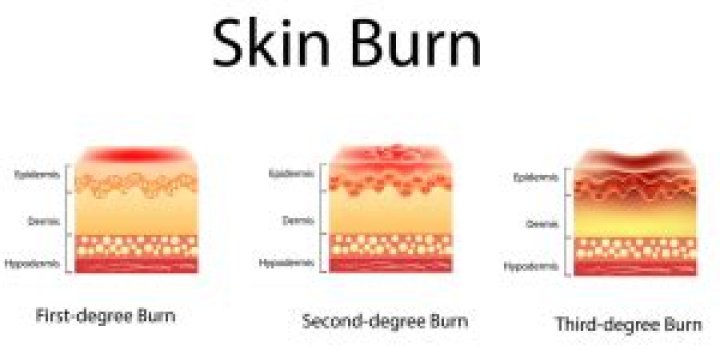 Why do burns hurt so much?