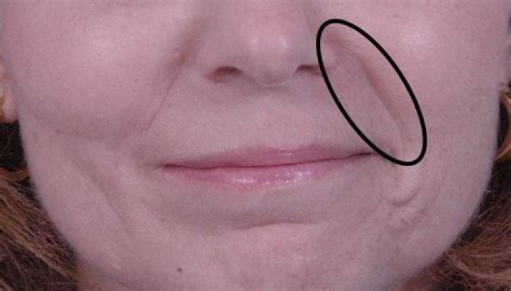 Why do I have lines from my nose to my mouth?