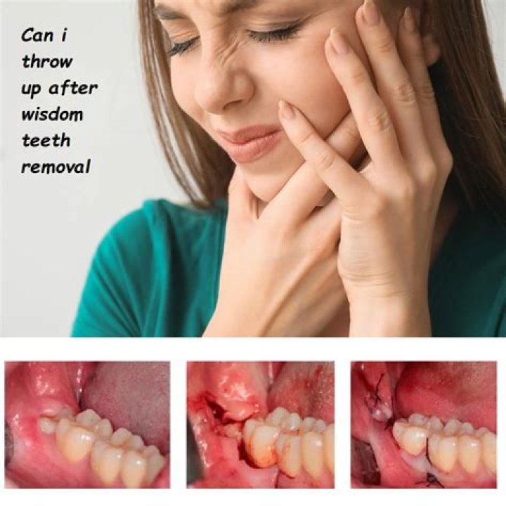 Why do you cry after wisdom teeth?