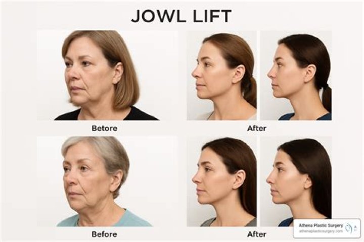Why do you get jowls as you age?