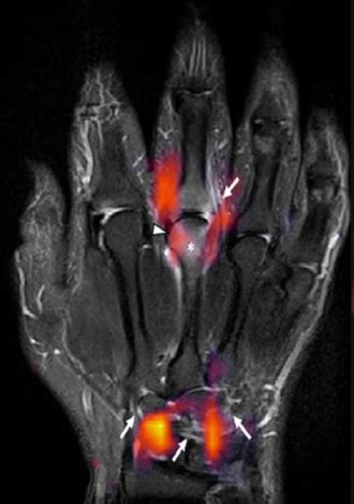 Will a MRI show arthritis?